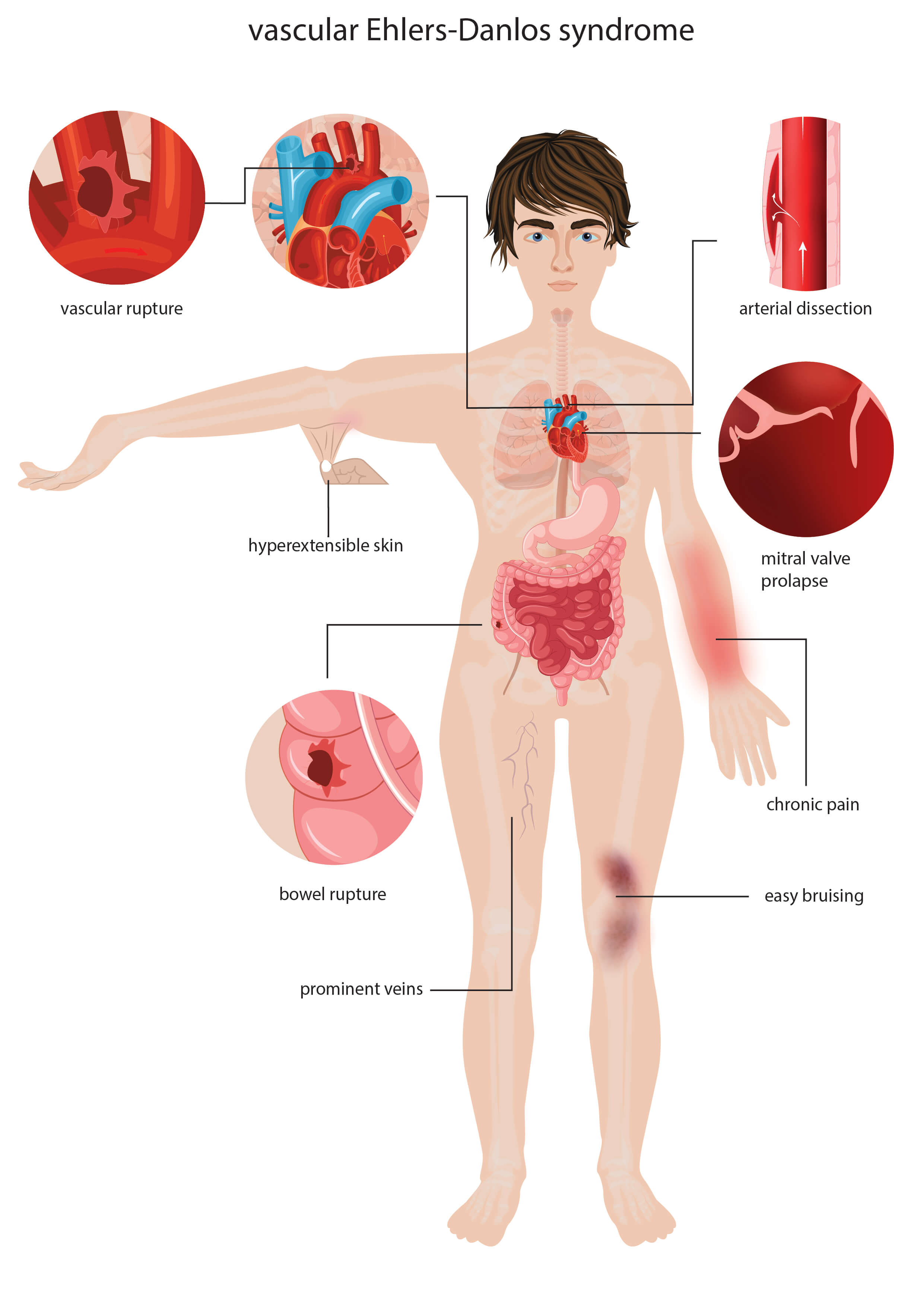 CareBridge preparing hEDS report mapped to 2017 International Classification criteria