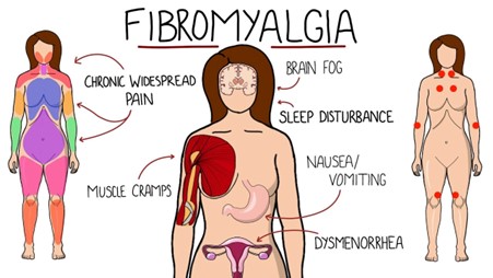 Person with fibromyalgia experiencing widespread pain